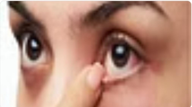 استشاري يوضح أسباب انتشار جفاف العين في منطقة الشرق الأوسط